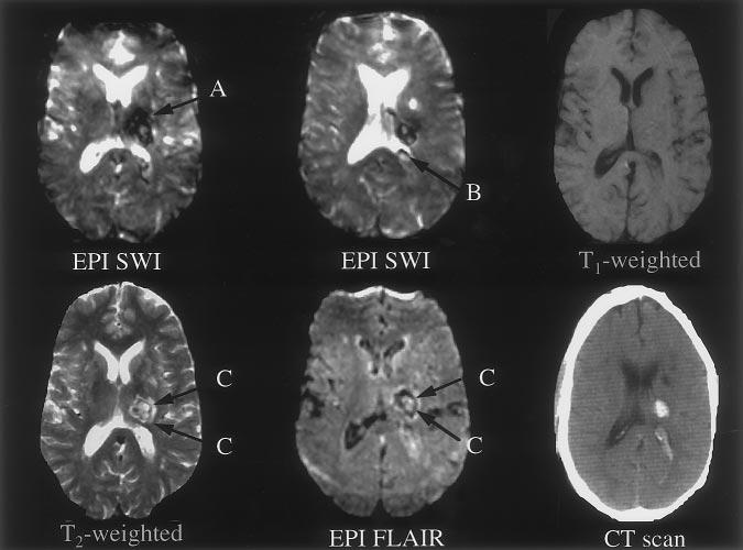 loss. SWI shows signal loss in the left thalamus (arrow A), most likely 3 hours after symptom onset, and a larger hyperintense area extending laterally and anteriorly into the white matter causing