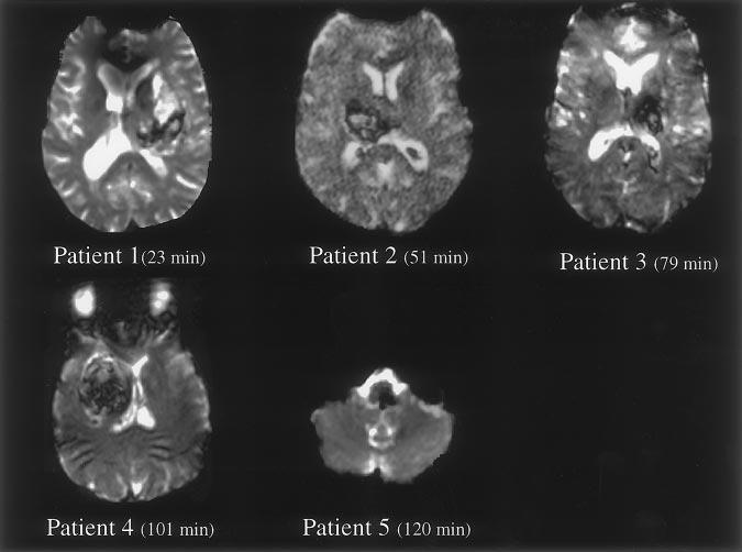 2266 Stroke November 1999 Figure 3. SWI of all 5 patients showing the pattern of temporal evolution of the signal changes in ICH.