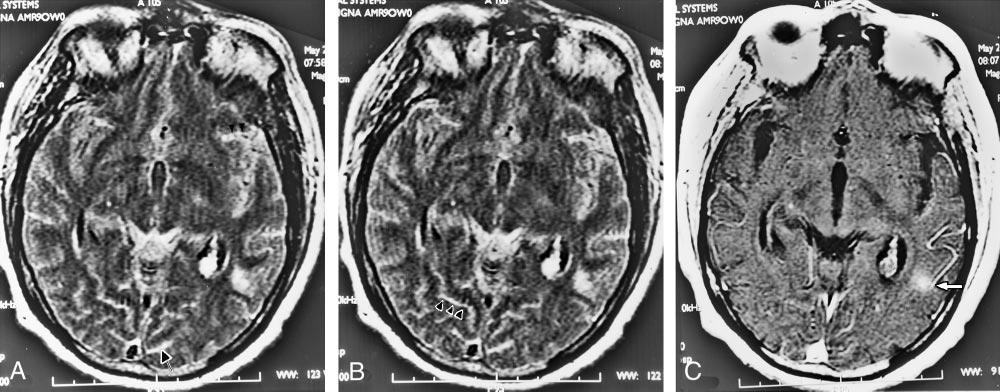 AJNR: 23, May 2002 LEPTOMENINGEAL METASTASES 819 FIG 1. Axial view MR images of a 41-year-old male patient with leptomeningeal metastases from laryngeal squamous cell carcinoma.