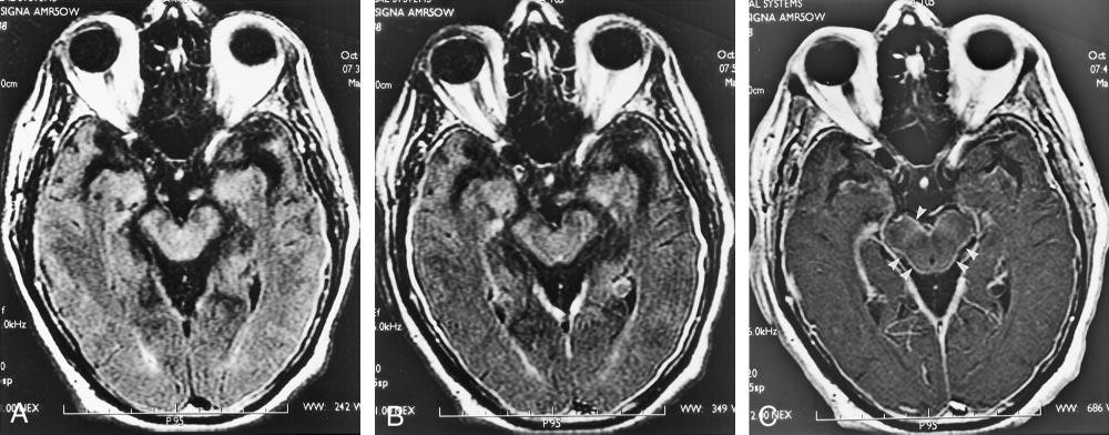 B, image (10,000/147; inversion time, 2200 ms) shows diffuse abnormal signal intensity in the subarachnoid space (arrowheads). C, T1-weighted MR image (600/8) is falsely negative.