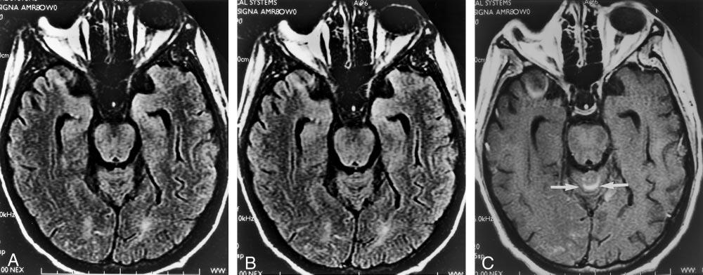 820 SINGH AJNR: 23, May 2002 FIG 3. Axial view MR images of a 26-year-old male patient with leptomeningeal metastases from leukemia.