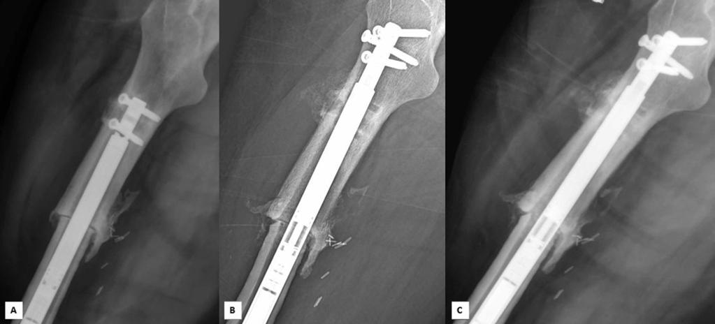 (Figure 5). The results are summarized in Table 2. Figure 4: Lateral radiographs of a femur after resection of a pleomorphic sarcoma and reconstruction with an 18-cm allograft.