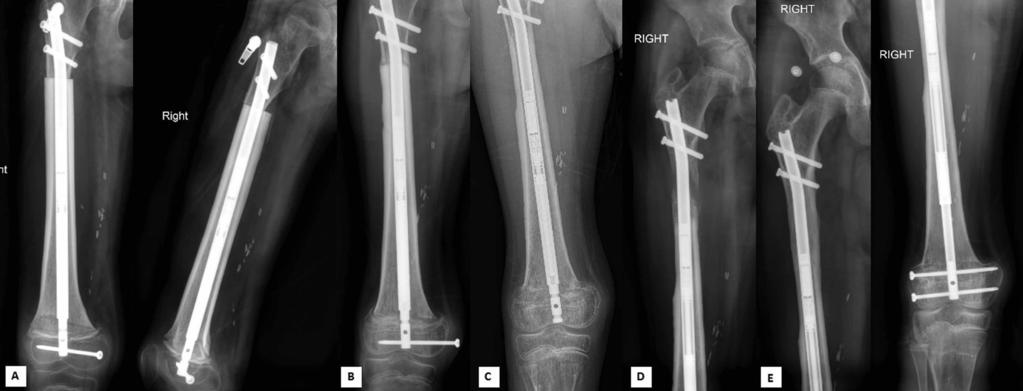 Good compression at the osteotomy site immediately after revision surgery (B). Healing of the osteotomy at 3.5 months after revision surgery (C). identified.