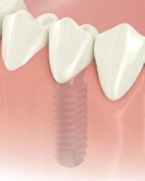 offer stabilisation of a complete denture.