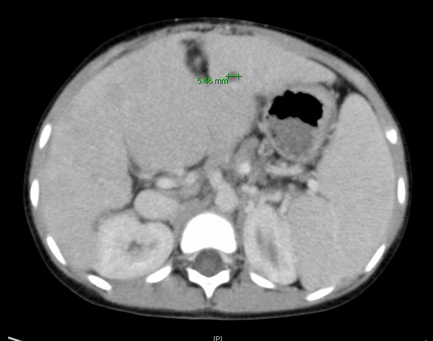 in the first two patients but IC was not controlled Intrahepatic cysts in