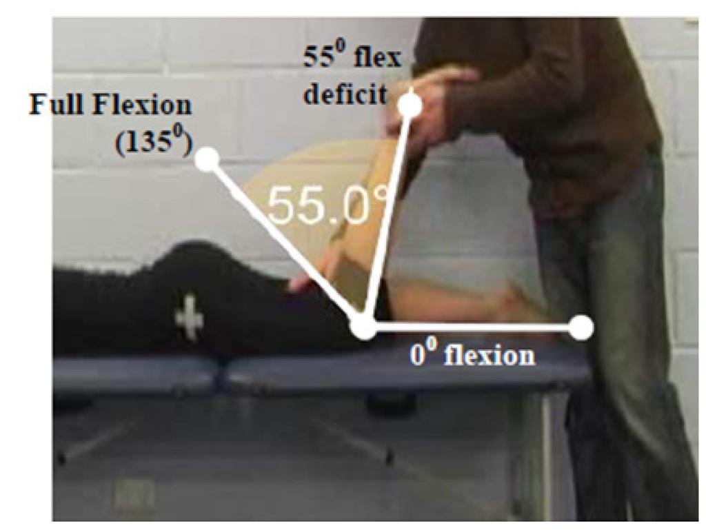 A 25 deficit is the maximum amount of hip extension that is permissible in order to meet this criterion. Athletes with 40 loss of extension meet the primary criterion for loss of hip PROM.