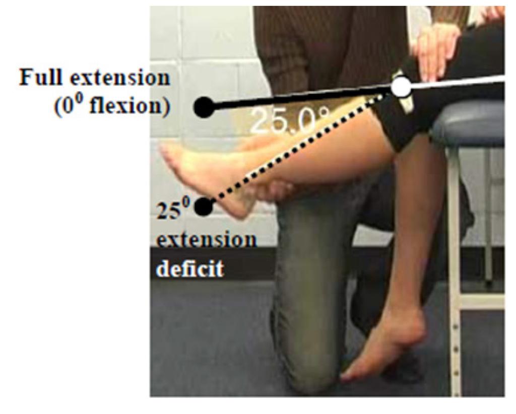 Secondary Criterion #4 Knee Extension deficit of 25 but < 35. The figure shows normal knee extension range i.e., 0 flexion (6) as well as a 25 extension deficit, the maximum amount of knee extension that is permissible in order to meet this criterion.