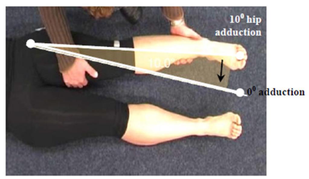 Primary Criterion #4 Hip Adduction loss of 4 muscle grade points (muscle grade of one).