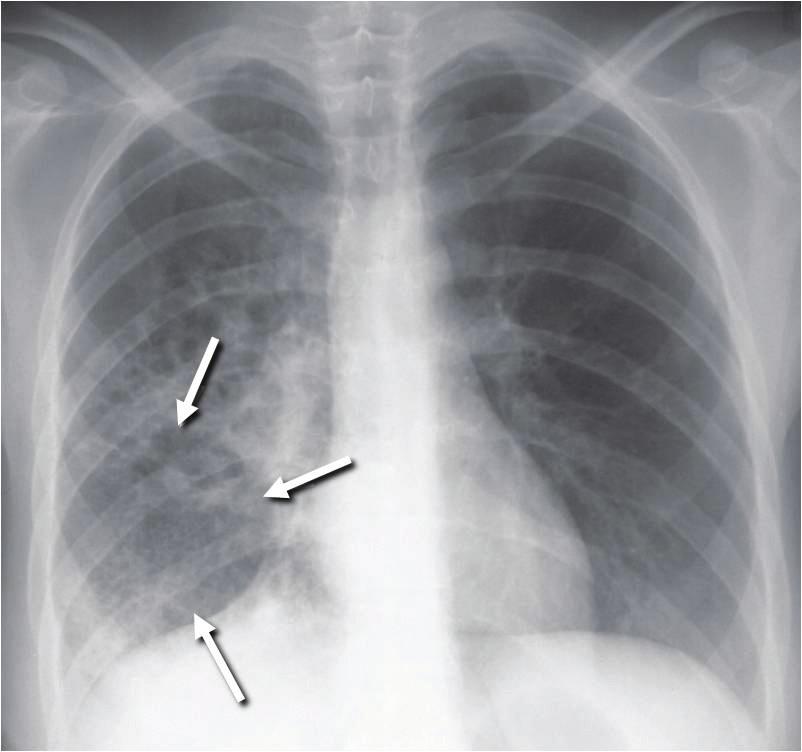 4. Chest Radiograph With pulmonary TB being the most common form of disease, the chest radiograph is useful for diagnosis of TB disease. Chest abnormalities can suggest pulmonary TB disease (Figure 4.