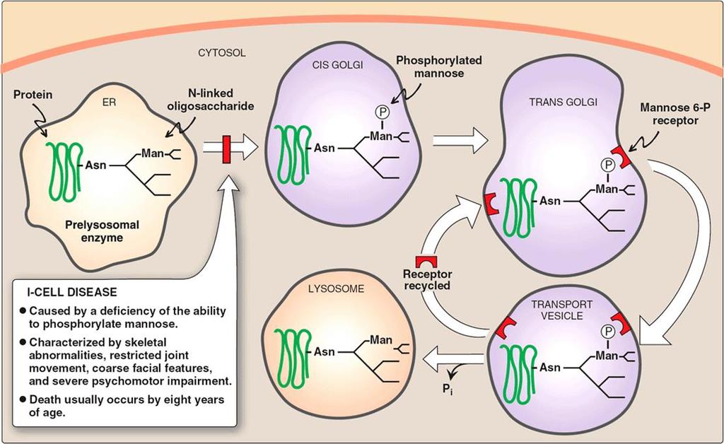 I-Cell Disease (Mucolipidosis type II) GlcNAc phosphotransferase deficiency Lysosomal enzymes do not