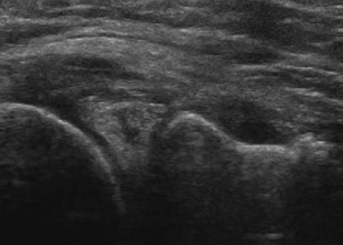 How to describe the Medial meniscus?