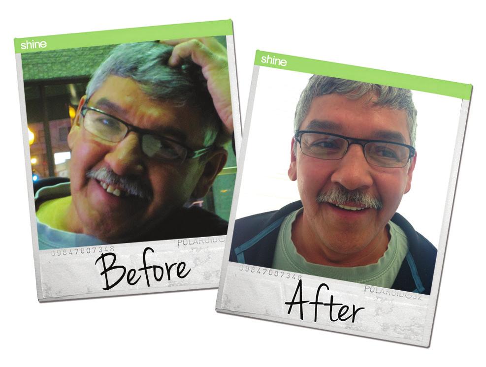 Ken came in looking at options for his damaged teeth. He knew he didn't want a removable denture and this made him a perfect candidate for our All-On-4 Teeth in a Day.