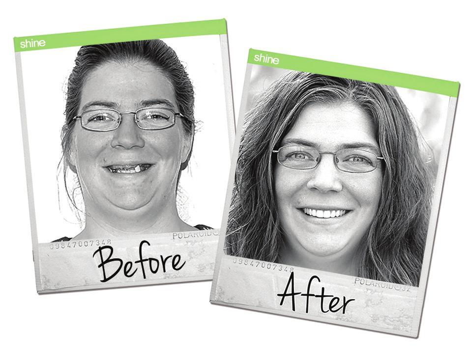 What is A Smile Makeover? A smile makeover involves one or more cosmetic dental procedures to improve not only the aesthetics of your smile but can also improve the overall function of your mouth.