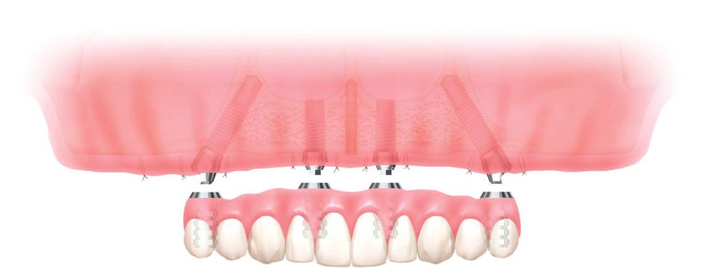 An All On 4 Prostheses secured by Dental implants are the most effective way to replace your missing teeth. Your baby teeth were your first set of teeth. Your adult teeth were your second set.