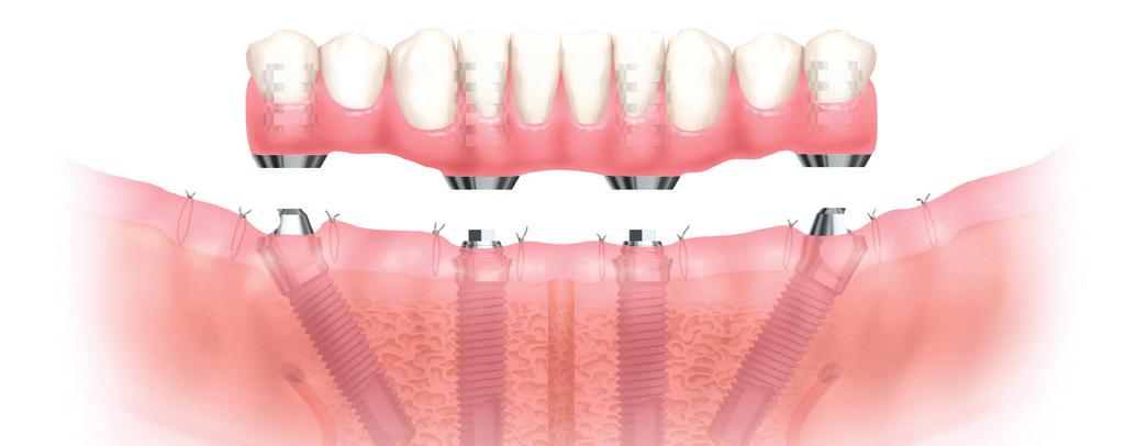 Artificial implants are attached to bone and become the 'roots' that keep the foundation solid. The dental bridge is then attached to these posts, creating a smile that is custom-fit just for you.