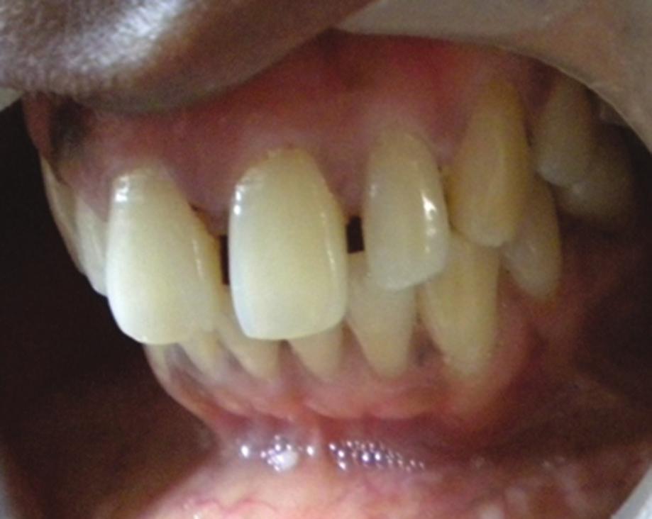 2. Patient with the complaint of recently formed diastema. 3. Patient with pathological migration of upper anterior teeth which is caused due to moderate to severe periodontal disease 4.
