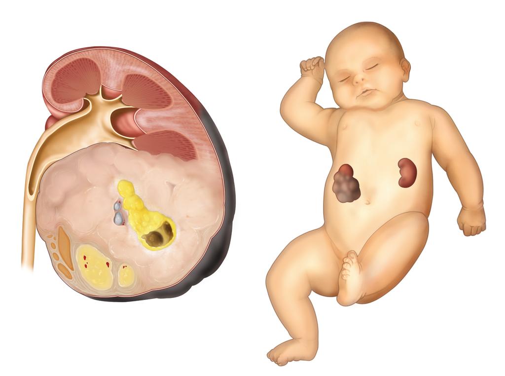 tumour is and whether it has spread beyond the kidney. This is known as staging of tumour. Urine and blood samples will also be taken to check your child s kidney function and general health.