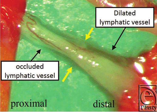 ICG indicates indocyanine green. Figure 3. The intraoperative finding of lymphaticovenous anastomosis. Distal side of the lymphatic vessel is dilated and the proximal side is shrunk.
