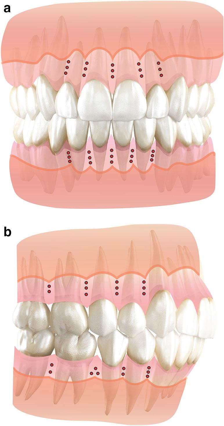 Clin Dent Rev (2018)2:4 Page 7 of 104 Fig. 4 Application of MOPs in the buccal cortical plate. Height of application of MOPs should be limited to the attached gingiva for patient comfort.