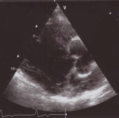 Figure 4. Aortic root dilatation (47 mm) in a 51-year-old male patient with Fabry disease.