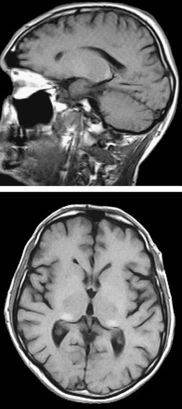 Figure 5. A T1 sagittal image showing a slight hyperintensity (yellow arrows) in the pulvinar area of a 46-year old male Fabry patient.
