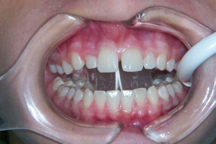 Isolation in Place: Dry the teeth prior to placing