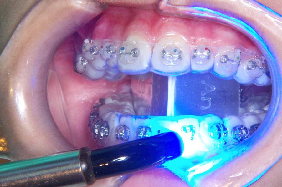 Light cure all lower teeth first.