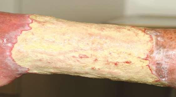 Dry fibrin - the wound edges show that fibrin