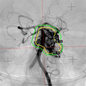 LEKSELL GAMMA KNIFE ICON EXAMPLES OF MICRORADIOSURGERY CASES BRAINSTEM AVM PITUITARY ADENOMA