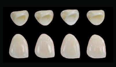 Your dental technician will veneer all the different IPS e.max frameworks with the highly esthetic IPS e.