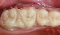 Inlays and veneers are cemented adhesively as usual.