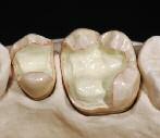 For IPS e.max Press restorations on abutments or implants, the procedure is the same as that on natural preparations.