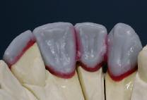 Reduce the contouring in the incisal third.