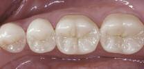 Use the following procedure for the fabrication of Table Tops: Apply the spacer to the preparation or tooth to be treated according to the partial crowns preparation guidelines (see page 15).