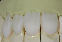 Restrict the cut-back to the incisal third Refrain from designing