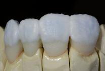 the individual esthetic appearance achieved. Use the IPS e.
