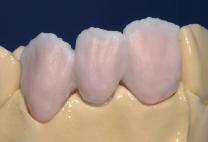 1 st Dentin and Incisal firing Perform the layering in accordance with the layering diagram (see IPS e.