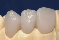 2 nd Dentin and Incisal firing (Corrective firing) Compensate for the shrinkage and complete the missing areas.