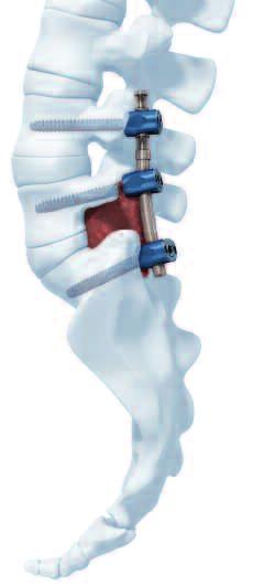 NFlex Principles Principles of dynamic stabilization The NFlex Stabilization System enables dynamic stabilization of the posterior lumbar spine (1).