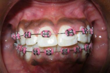 Common problems are those with Orthodontic treatment is a long term treatment procedure, going for several months and for this reason it is requires good commitment from child and parent alike.