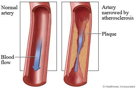Atherosclerosis Once an injury exists on the artery, white blood cells,