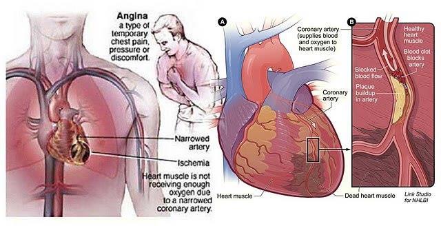 Coronary Heart Disease Ischemia - insufficient supply of oxygen and nutrients to tissue, caused