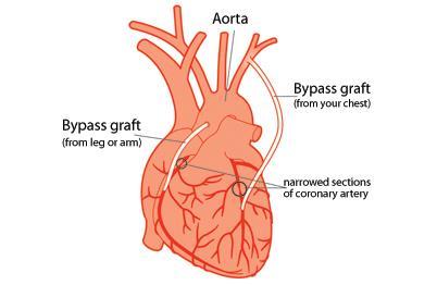 Coronary Artery Bypass Grafting 31 Congestive Heart Failure Usually follows a severe heart attack Heart s pumping power is weaker than normal Chambers of the heart stretch to hold more blood, or