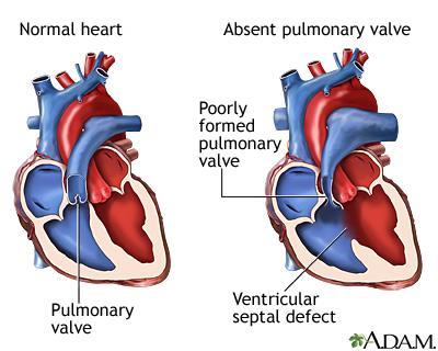 Cardiovascular Diseases Congenital