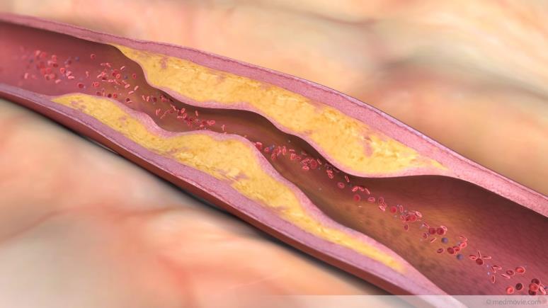 Atherosclerosis The disease process underlying