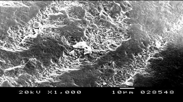 Scanning electron microscopy after 48 hours of demineralization Figure10. SEM image of Group I showing irregular pattern of surface destruction (x1000).