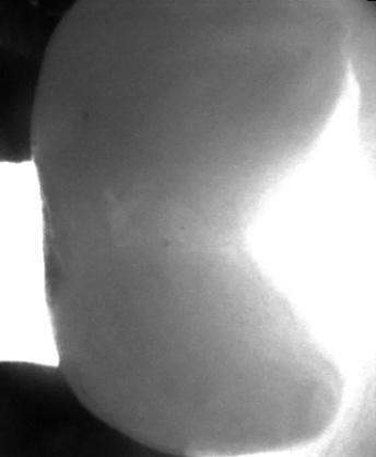 DIAGNOcam image showing (Score 1) carious demineralization of the mesial surface of an upper left 1 st premolar. Figure14.