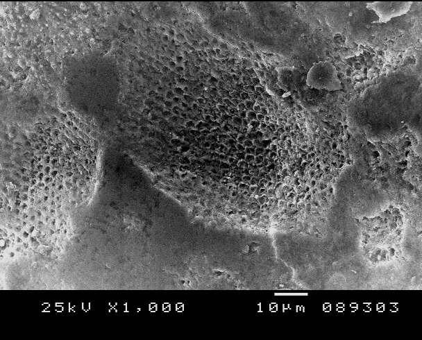 All scanning electron microscopy images the typical honeycomb appearance indicating showed demineralized carious enamel with prismatic pattern destruction where the prism irregular pattern of surface