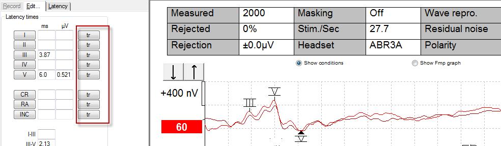 Eclipse Additional Information Page 57 Show Standard deviation on EMG graph when testing VEMP, the standard deviation is displayed on the grap Leave intensity checkmark on When enabled the intensity