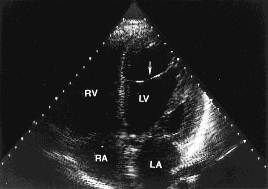 VT originates from a false tendon extends from posteroinferior left